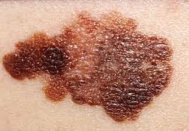 Telltale signs of Melanoma. Photo credit: Wikipedia